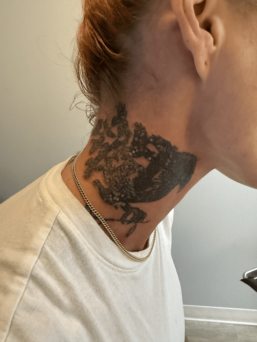 Laser tattoo removal