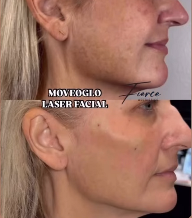 IPL Photofacial